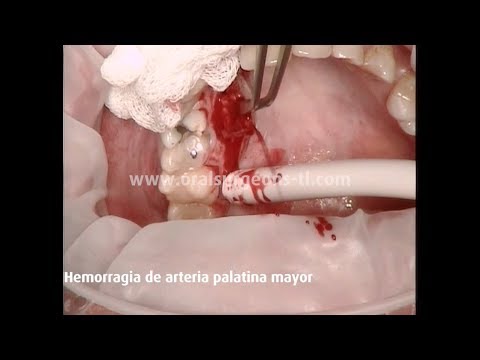 Una dental detener como hemorragia