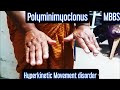 Polyminimyoclonus- Hyperkinetic Movement Disorder #mbbs #medicine #neetpg #neet #aiims #usmle