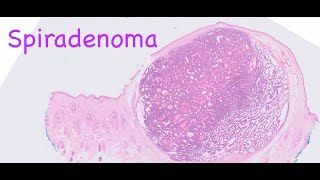 Spiradenoma