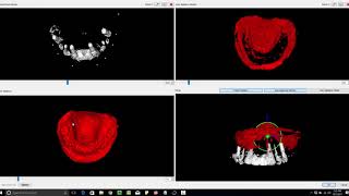 BSP Case Review: Difficult Alignment - Impression with Markers