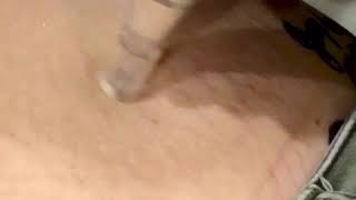 Micro-needling for Stretch Marks
