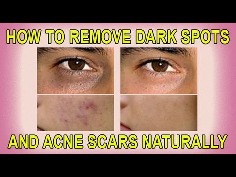 How to Remove Dark Spots and Acne Scars Naturally - YouTube