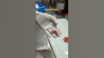 Appendix specimen gross 🤢| #histopathology #histomuseum #appendicitis #appendixcarry #appendix #lab
