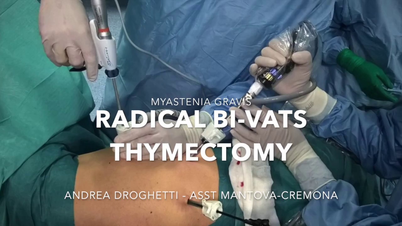 Vats Radical Thymectomy for Myasthenia Gravis Andrea Droghetti YouTube