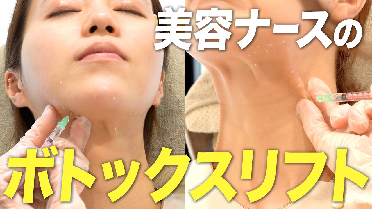 【広頚筋ボトックス】首の筋肉がたるみの原因！？ボトックスでリフトアップ！