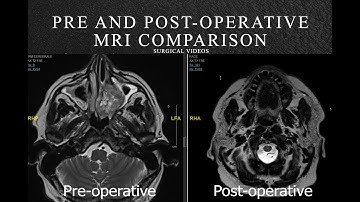 Pre and Post-operative MRI comparison