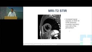 Pericardial Cases: Does Pericarditis Ever Get Better?