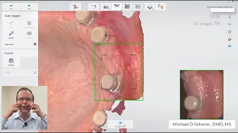 LOCATOR Scan Body! - How to Scan Intraoral Scanning Edentulous Ridges using LOCATOR Scan Bodies