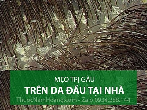 Tư vấn - Mẹo trị GÀU tại nhà hiệu quả với Vảy gàu, Ngứa và Rụng tóc [2019]