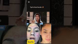 Acne Treatment  by Dr Bilquis l👍# acneremove #shorts # viralshort #foryou screenshot 1