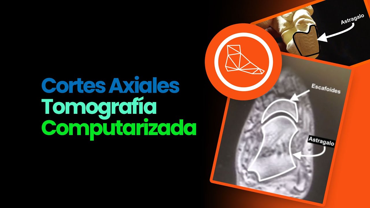 Cortes axiales del pie en una tomografía computarizada - YouTube