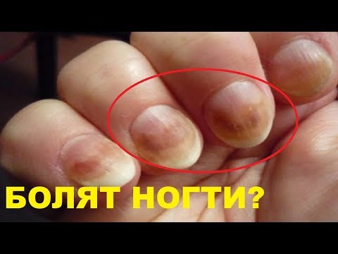 Болят ногти? Почему болят ногти на пальцах рук и ног, основные причины боли в ногтях