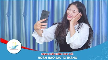 NIỀNG RĂNG KHẤP KHỂNH - THAY ĐỔI HOÀN HẢO SAU 13 THÁNG