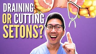 Seton: Draining or Cutting? | Anal fistula surgery