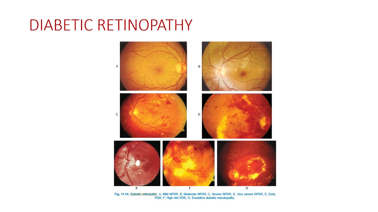 Ophthalmology Diabetic reinopathy + hypertensive retinopathy YouTube