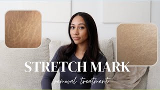 STRETCH MARK REMOVAL TREATMENT: MY RESULTS.