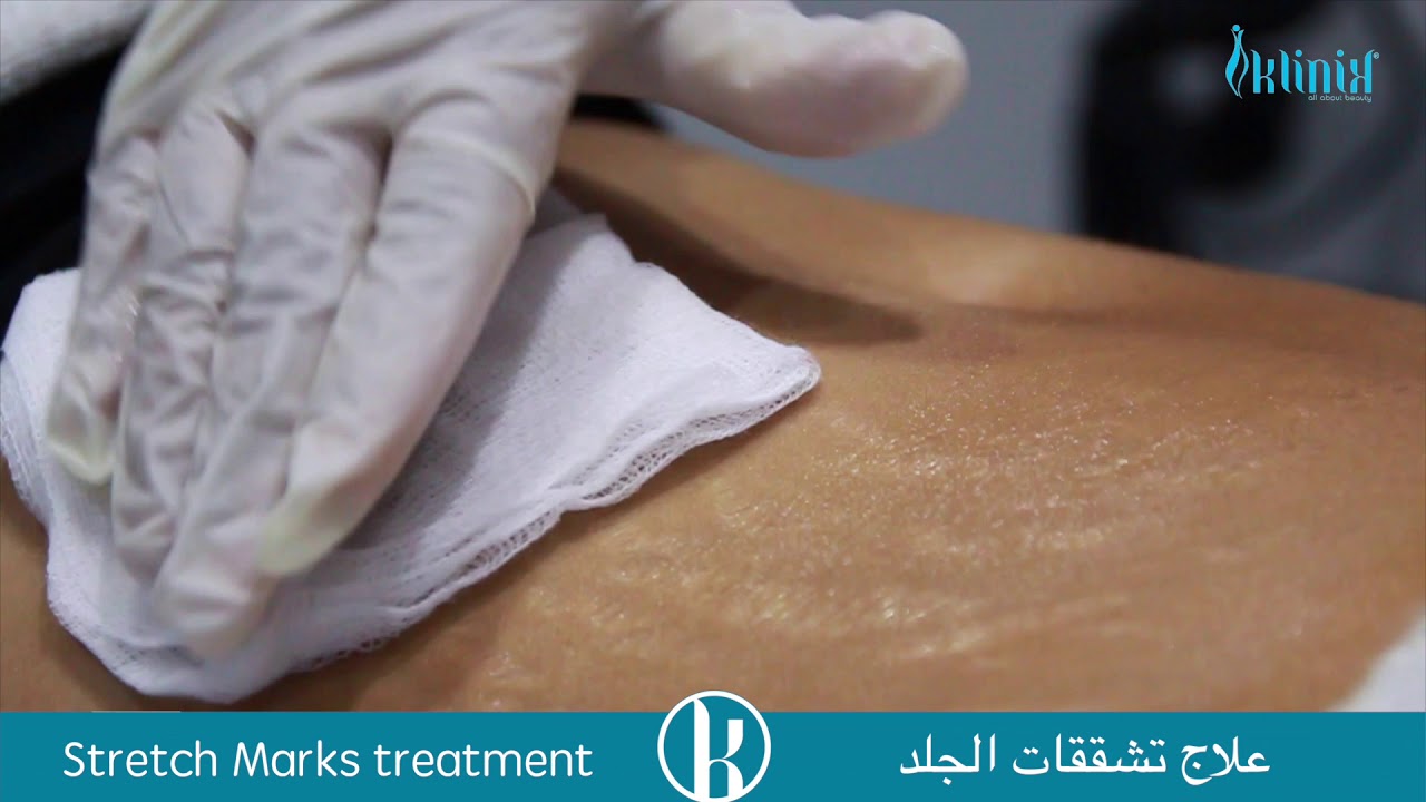 Treatment of stretch marks with co2