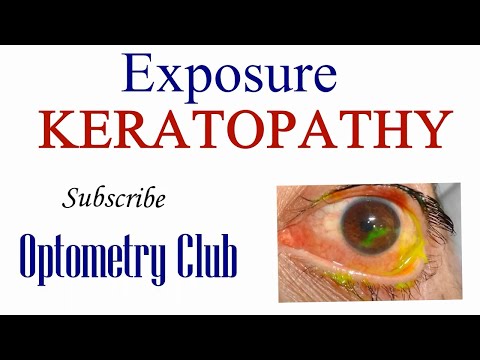 Exposure Keratopathy Introduction, Signs, Symptoms, Diagnosis and Treatment