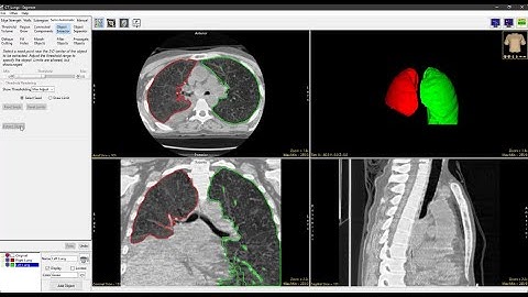 Analyze 15.0 - Segment: Multiple CT Object Segmentation using Object Extractor