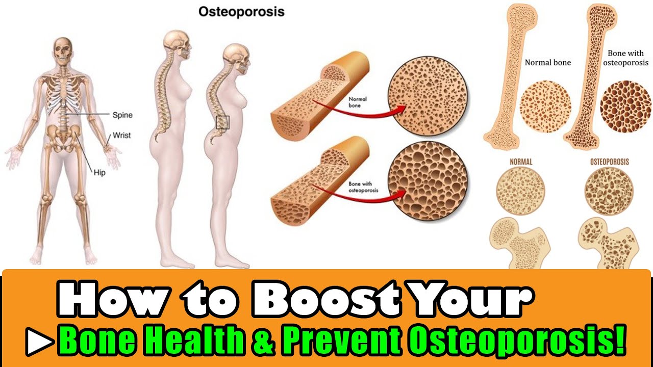 How to Boost Your Bone Health & Prevent Osteoporosis #bonehealth # ...