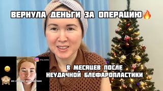 Результат после неудачной блефаропластики на азиатские глаза/ прошло 8 месяцев