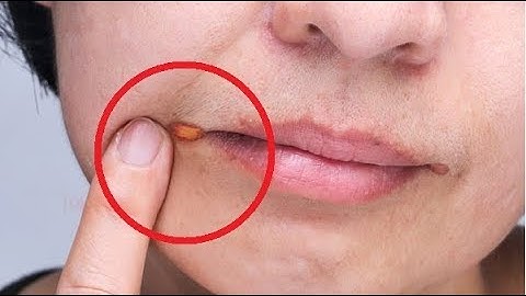 Home Remedies for Angular Cheilitis