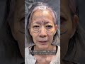 母親と同じように全部顔を出していただく全顔モニター様★60代女性、切開式たるみ取りフルコース：切開リフト、前額リフト、クマ取り、眉下切開