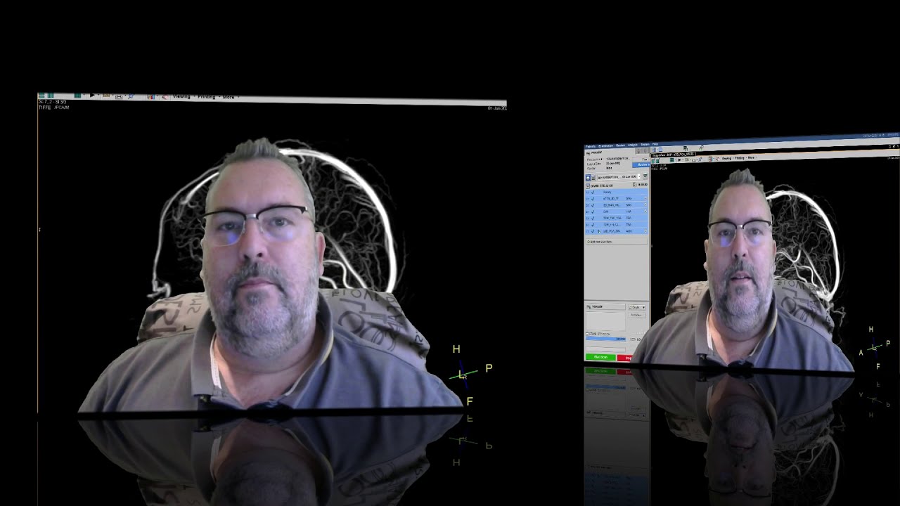 2 trucos para secuencias vasculares Phase Contrast