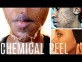 CHEMICAL PEEL! | Full Peeling Process |BEFORE & AFTER | How To Get Rid of Hyperpigmentation