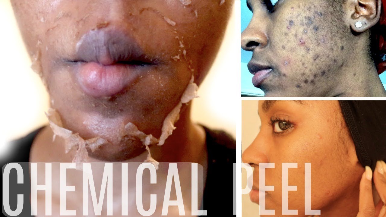 5. TCA Chemical Peel - wide 5