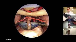 Endoscopic Transclival Approach - Askin Seker, M.D. - Endoscopic Anatomy