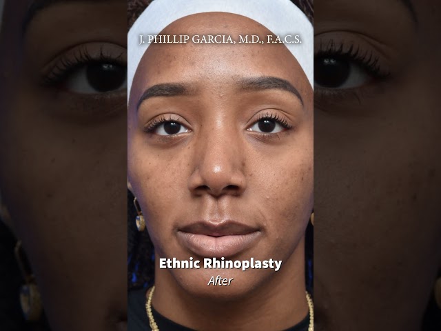 Ethnic Rhinoplasty