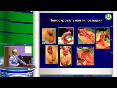 Видео: Расщепление пениса: методы, безопасность, влияние на фертильность и многое другое