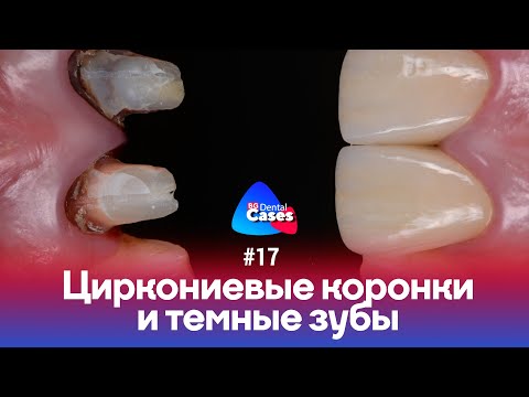 Video: Čo Robiť, Ak Bolí Zub Pod Korunkou