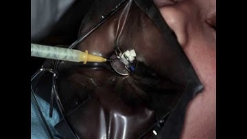 Maxillary 2nd Bicuspid (#4) Light-Cured Composite Utilizing a Sectional Matrix  A Time Saving