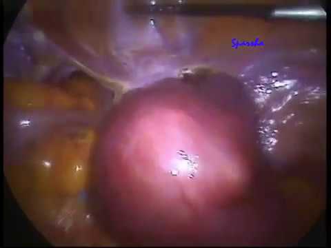 Unedited Video Of TLH (Total Laparoscopic Hysterectomy) Large Uterus With Fibroid