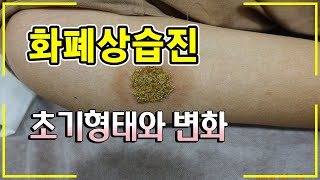 화폐상습진 초기의 모습과 환부의 변화