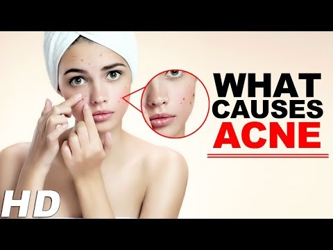 What Are The Real Causes Of Acne Or Pimples On Face | Know The Reasons For Acne - Healthy Life Aim