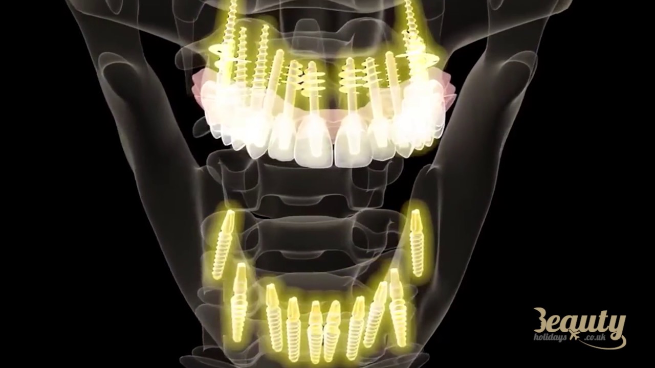 Dental Implants Without Bone Grafting YouTube