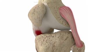 Kinematic Alignment 3D Video animation showing the main steps of TKA procedure Resimi