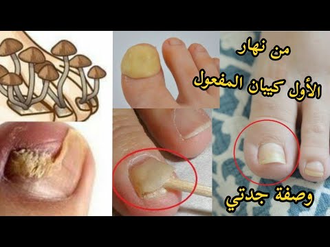 ادهنيها لأظافرك كل يوم وتخلصي تماما ونهائيا من فطريات الاظافر مجربة وفعالة 100%