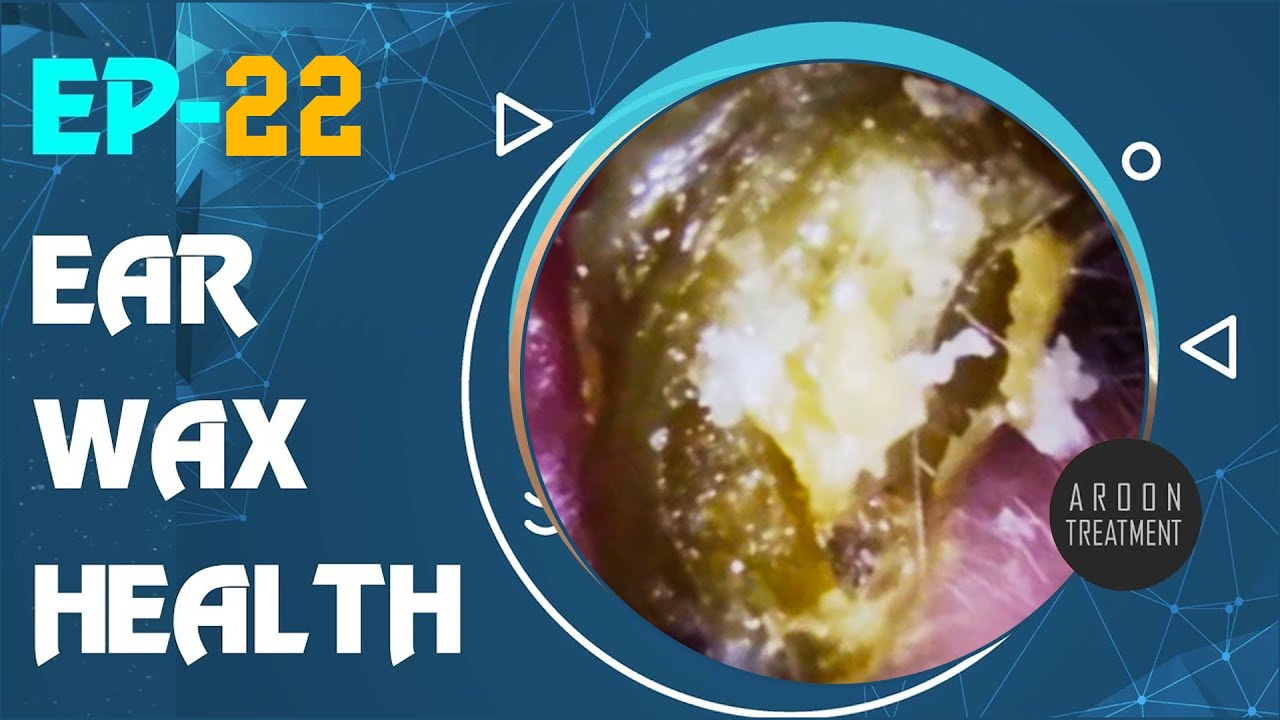 Most satisfying ear wax removal with microscope 22 YouTube
