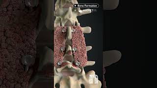 How MagnetOs can help you achieve a more predictable fusion | Medical Animation | MoA Animation