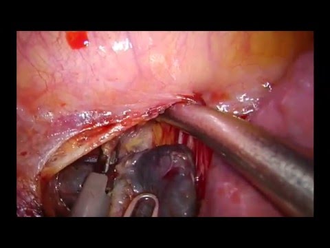 Uniportal VATS lymph node dissection on the left side