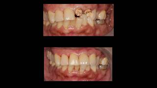 Anterior Restoration #zirconia #fiberpost #metalfreecrown