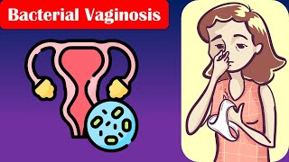 Bacterial Vaginosis - Causes, Risk Factors, Signs & Symptoms, Diagnosis, And Treatment