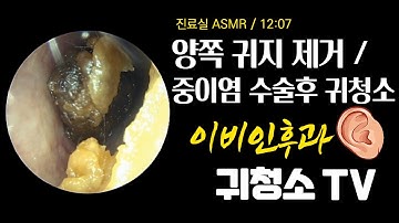 양쪽 귀지 제거 / 중이염 수술후 귀청소 (ear wax removal)