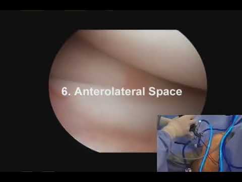 Knee Arthroscopy Basic points