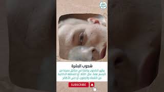 اعراض نقص الحديد في الجسم shorts foryou fyp foryourpage