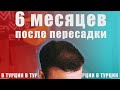 Пересадил волосы в Турции за 1200 $ | После 6 месяцев | Облысение | Серия 3